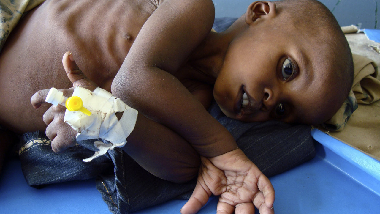 Podvyiven 3let somlsk chlapec v nemocnici v Mogadiu