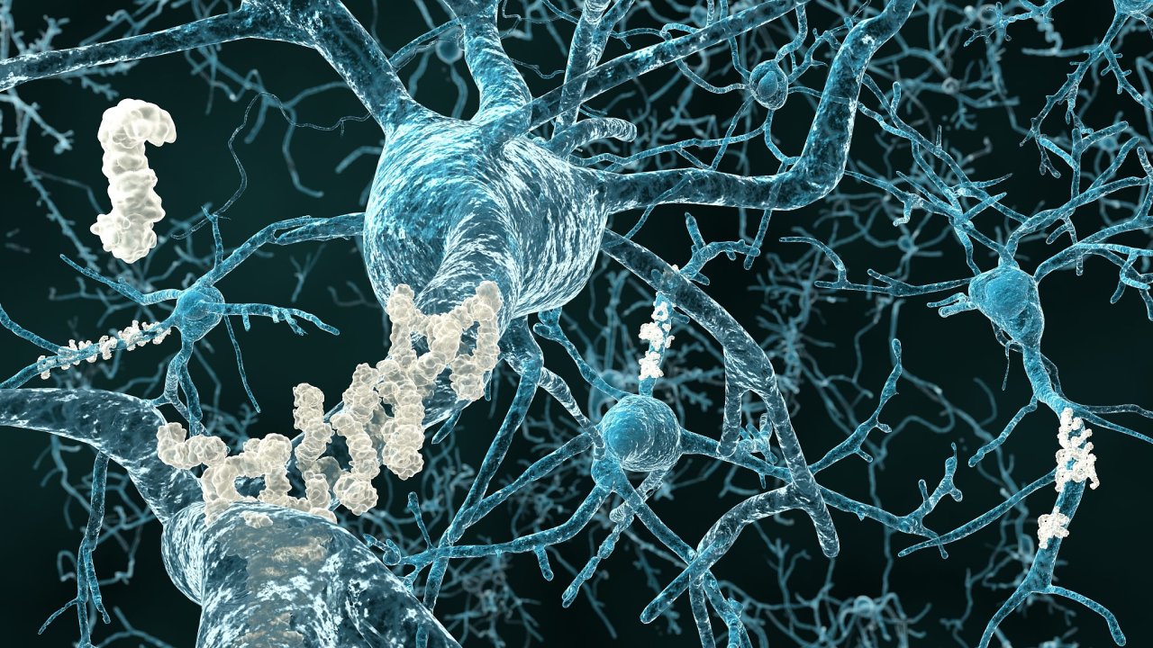 Amyloid beta (svìtlejší vlákna ve 3D vizualizaci) se hromadí v mozku pacientù s Alzheimerovou chorobou a vyvolává masivní destrukci nervových bunìk.
