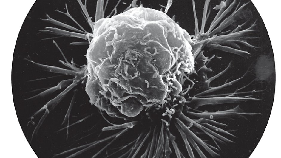 Rakovina pod mikroskopem. Ilustran foto