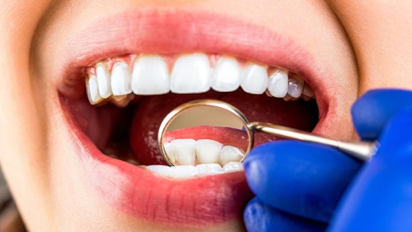 Nebezpečné zubní kazy? Vědci vyvinuli gel na léčbu poškozené skloviny