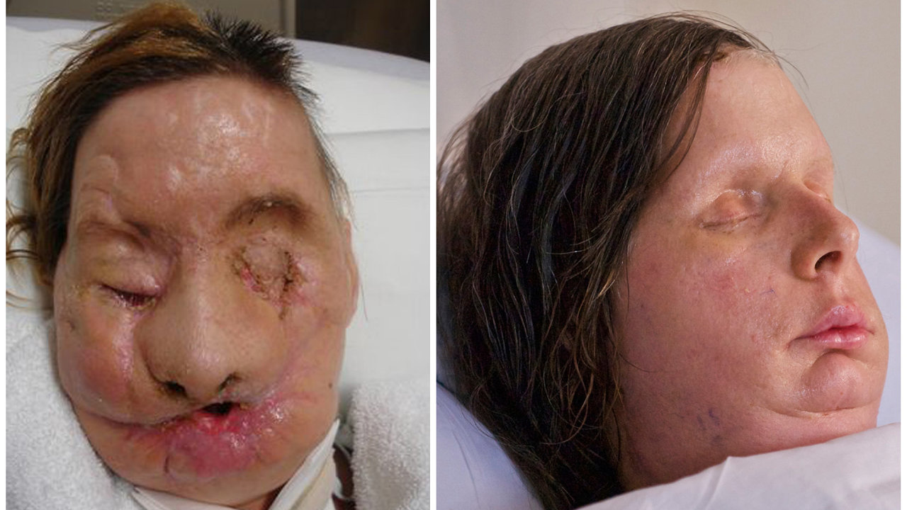 Transplantace oblièeje ženy pokousané šimpanzem
