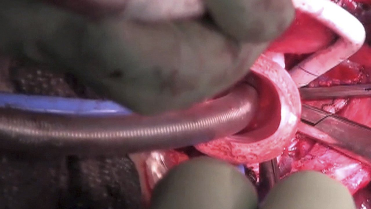 Implantování prùdušnice pacientu ve Švédsku