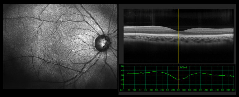 Optická koherenční tomografie (OCT) je moderní zobrazovací metoda, která podrobně v řezech znázorňuje stav sítnice a zrakového nervu.