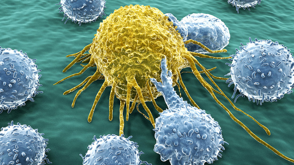 Chronická lymfocytární leukémie, ilustraèní foto